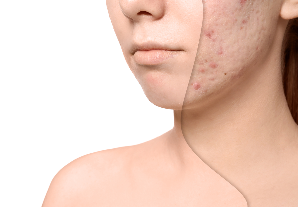 Acne scars treatment
